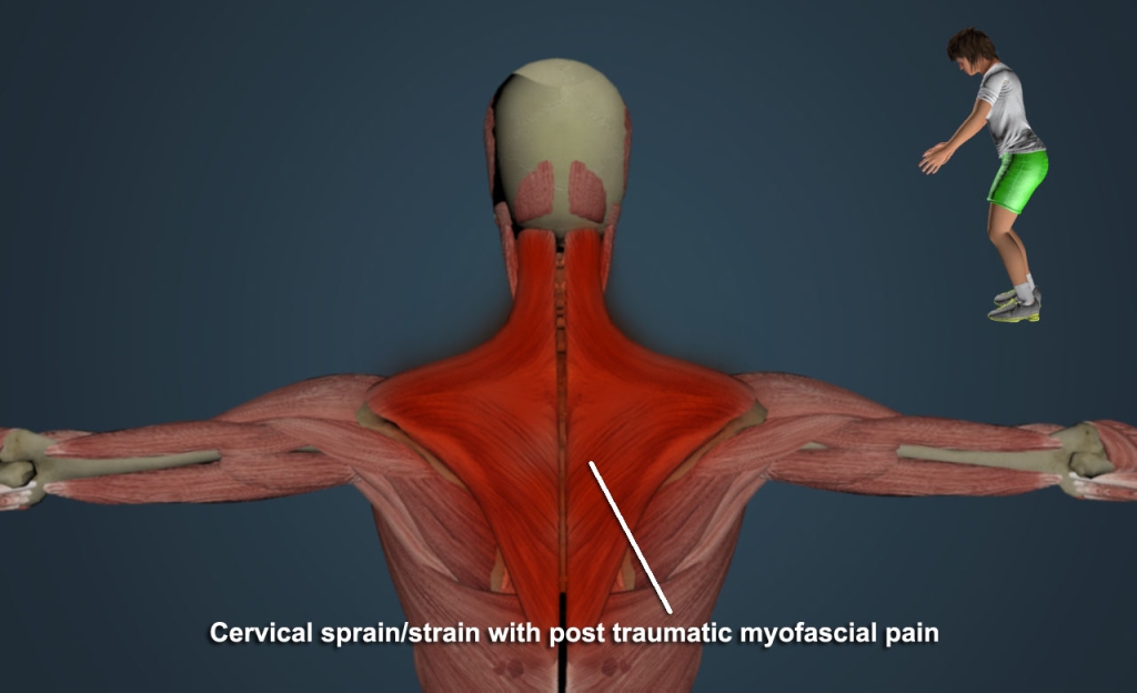 InjuryBack1