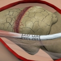 Surgery3